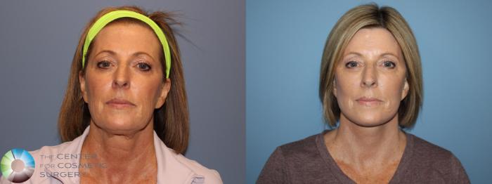 Before & After SMAS Facelift Case 12208 Front in Denver and Colorado Springs, CO