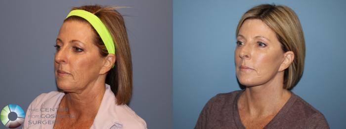 Before & After SMAS Facelift Case 12208 Left Oblique in Denver and Colorado Springs, CO