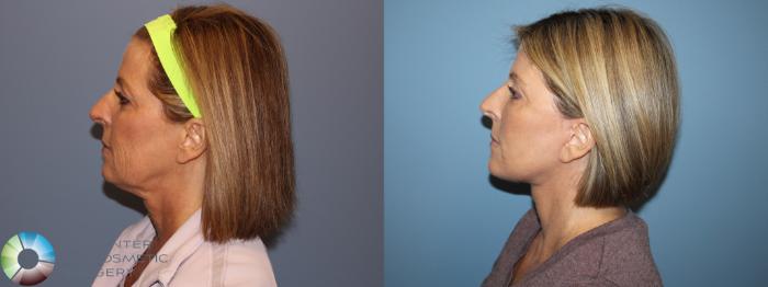 Before & After SMAS Facelift Case 12208 Left Side in Denver and Colorado Springs, CO