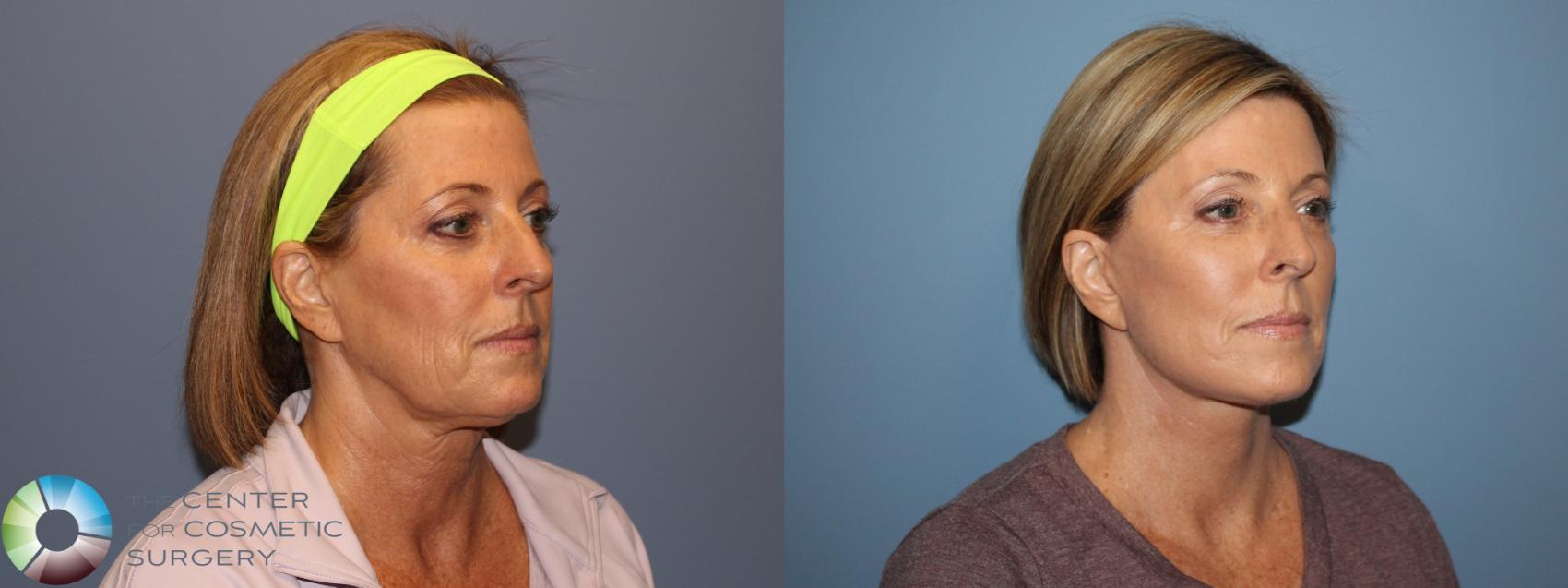Before & After SMAS Facelift Case 12208 Right Oblique in Denver and Colorado Springs, CO