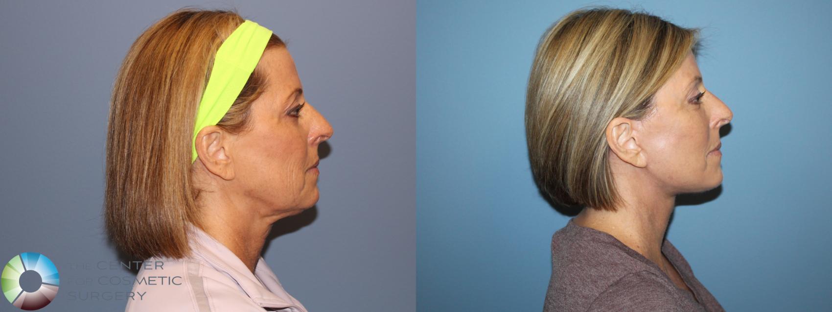 Before & After SMAS Facelift Case 12208 Right Side in Denver and Colorado Springs, CO
