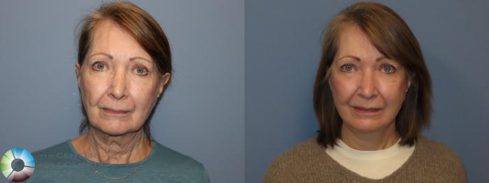 Before & After Mini Facelift Case 12209 Front in Denver and Colorado Springs, CO