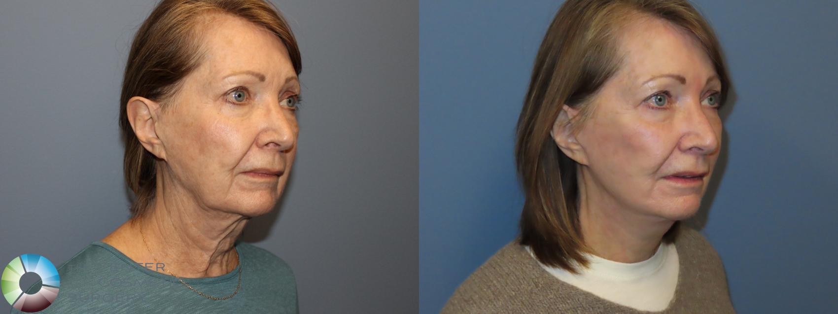 Before & After SMAS Facelift Case 12209 Right Oblique in Denver and Colorado Springs, CO