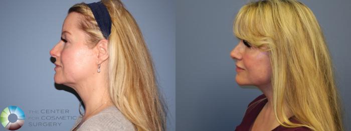 Before & After SMAS Facelift Case 12210 Left Side in Denver and Colorado Springs, CO
