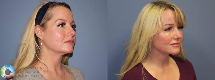 Before & After SMAS Facelift Case 12210 Right Oblique in Denver and Colorado Springs, CO