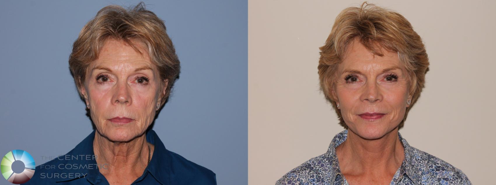 Before & After SMAS Facelift Case 12211 Front in Denver and Colorado Springs, CO