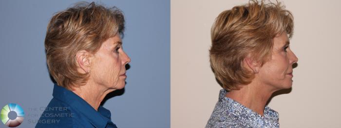 Before & After SMAS Facelift Case 12211 Right Side in Denver and Colorado Springs, CO