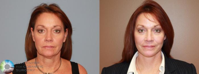 Before & After Eyelid Lift Case 12212 Front in Denver and Colorado Springs, CO