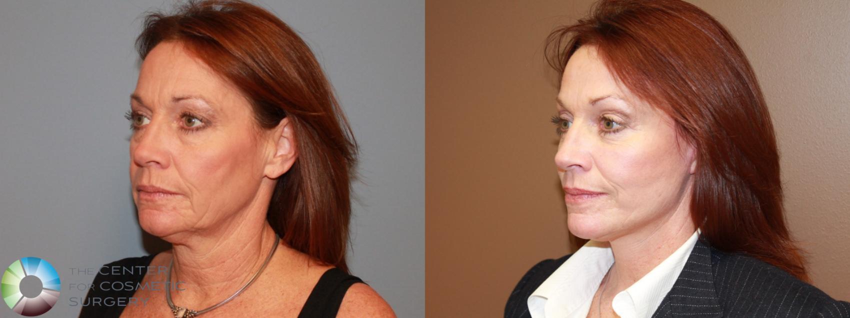 Before & After SMAS Facelift Case 12212 Left Oblique in Denver and Colorado Springs, CO
