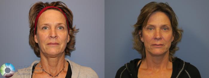 Before & After SMAS Facelift Case 12213 Front in Denver and Colorado Springs, CO