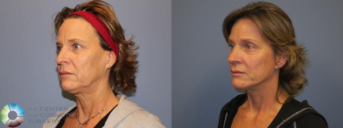 Before & After SMAS Facelift Case 12213 Left Oblique in Denver and Colorado Springs, CO