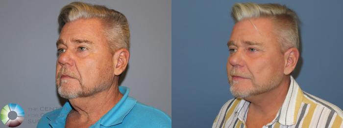 Before & After SMAS Facelift Case 12214 Left Oblique in Denver and Colorado Springs, CO