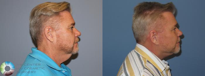 Before & After SMAS Facelift Case 12214 Right Side in Denver and Colorado Springs, CO