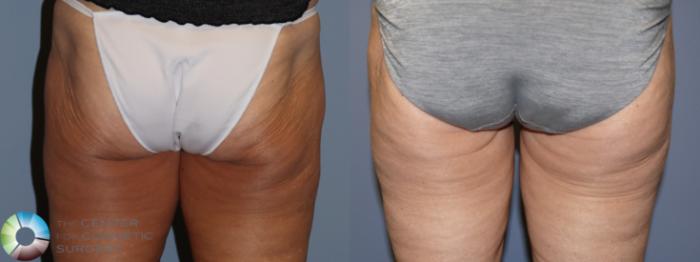 Before & After Thigh Lift Case 11865 Back View in Golden, CO