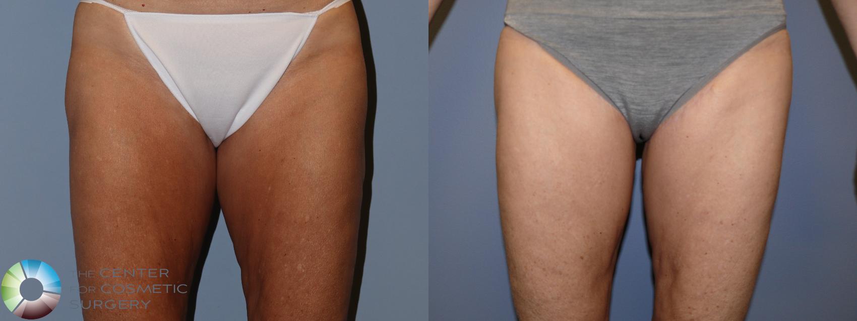 Before & After Thigh Lift Case 11865 Front in Denver and Colorado Springs, CO