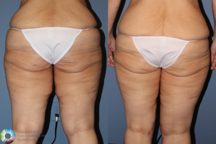 Before & After Thigh Lift Case 11866 Back in Denver and Colorado Springs, CO
