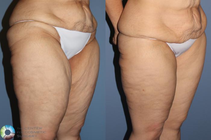 Before & After Thigh Lift Case 11866 Right Oblique in Denver and Colorado Springs, CO