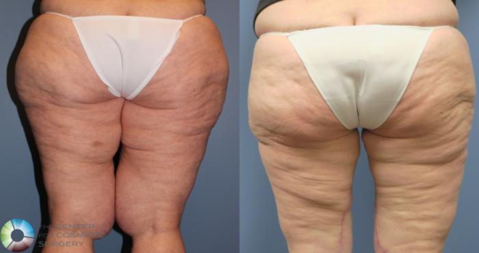 Before & After Thigh Lift Case 11867 Back in Denver and Colorado Springs, CO