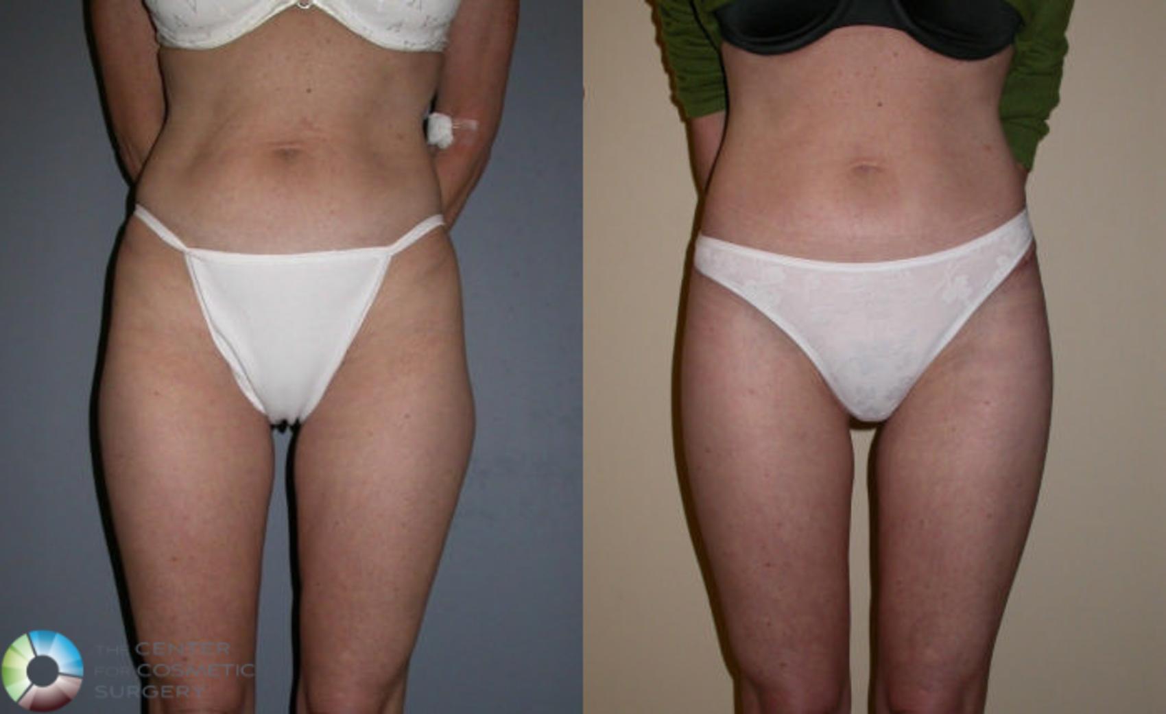 Before & After Thigh Lift Case 62 View #2 View in Denver & Golden, CO