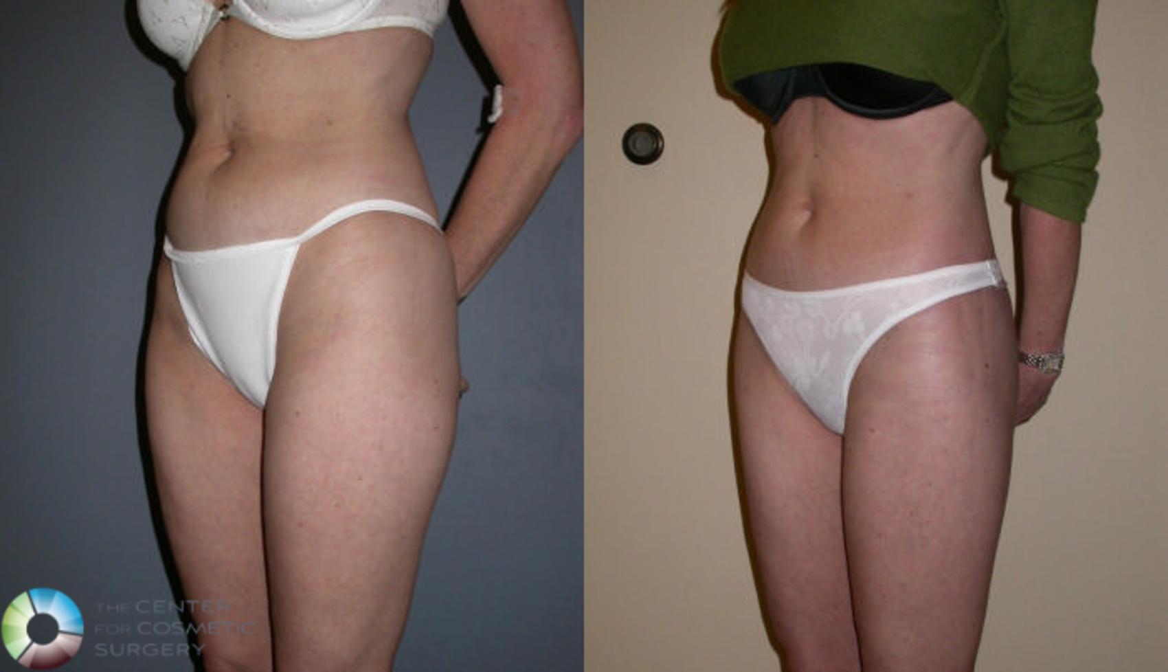 Before & After Thigh Lift Case 62 View #3 View in Denver & Golden, CO