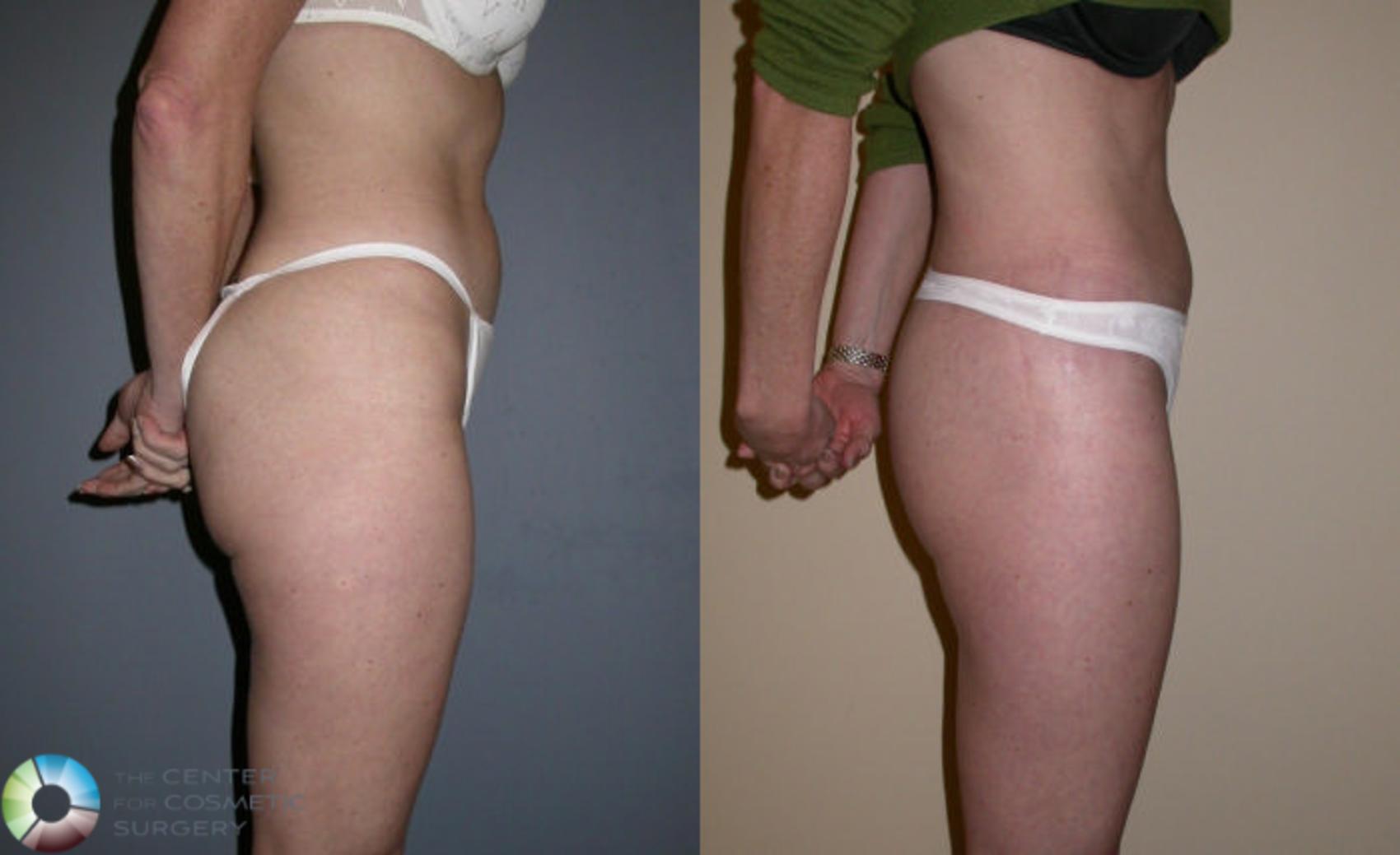 Before & After Thigh Lift Case 62 View #4 View in Denver & Golden, CO