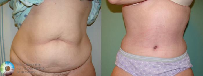 Before & After Tummy Tuck Case 10998 Anterior in Denver and Colorado Springs, CO