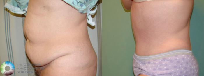 Before & After Tummy Tuck Case 10998 Left Lateral in Denver and Colorado Springs, CO