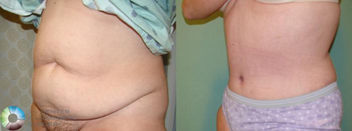 Before & After Tummy Tuck Case 10998 Left Oblique in Denver and Colorado Springs, CO