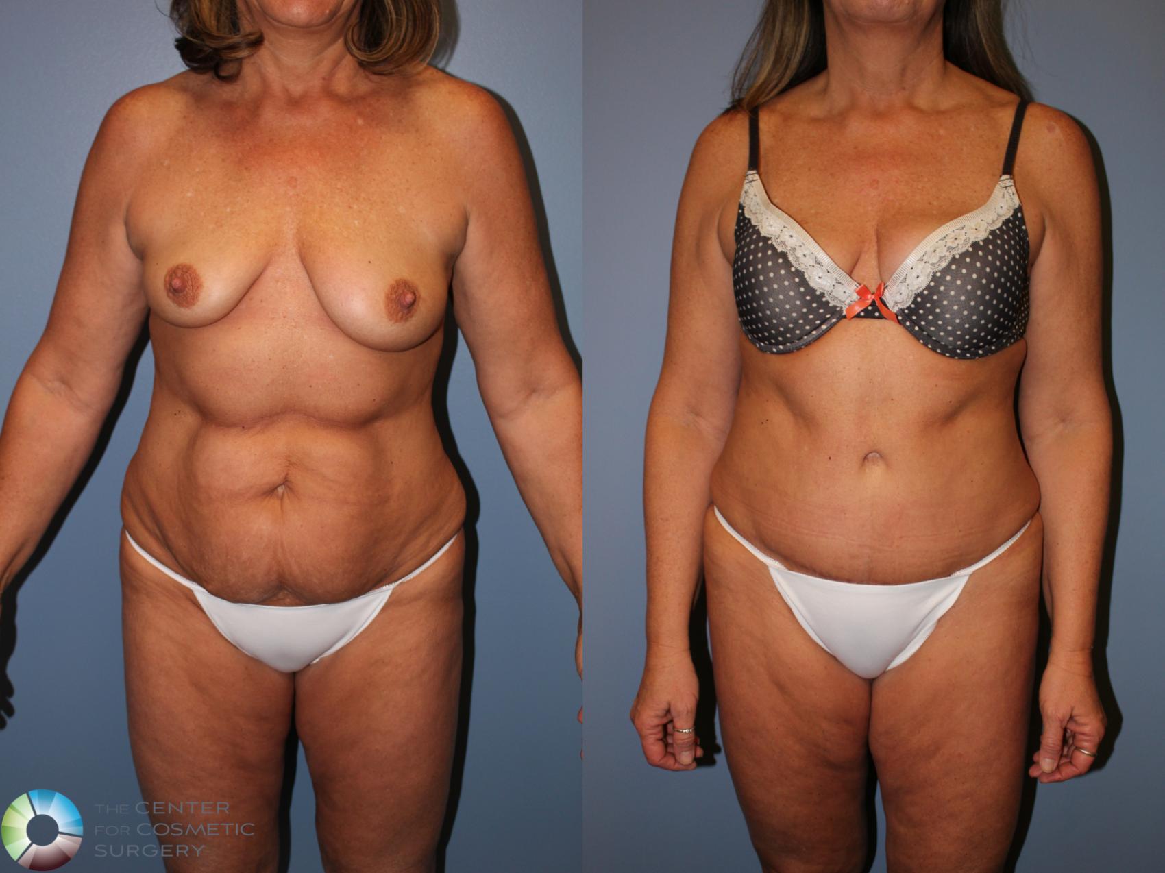 Before & After Tummy Tuck Case 11240 Front View in Golden, CO