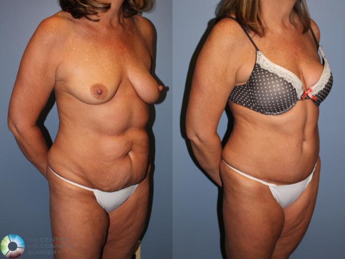 Before & After Tummy Tuck Case 11240 Right Oblique View in Golden, CO