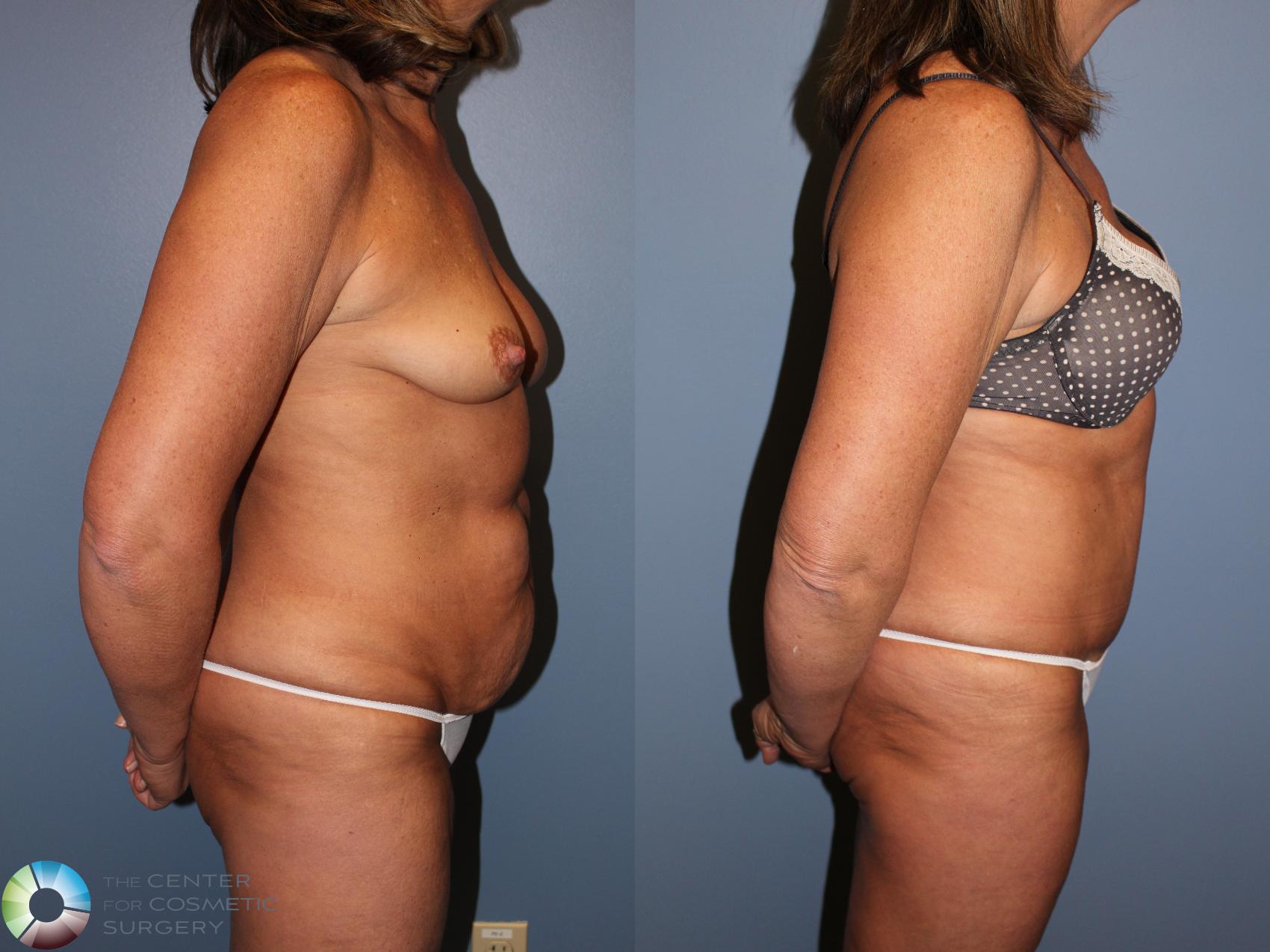 Before & After Tummy Tuck Case 11240 Right Side View in Golden, CO
