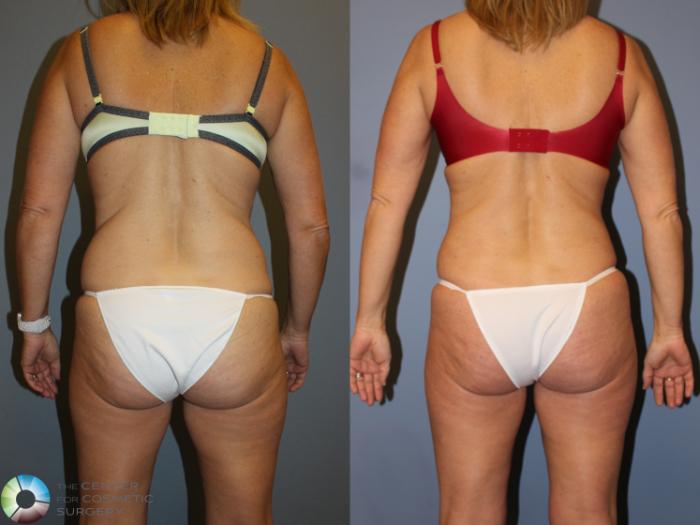 Before & After Tummy Tuck Case 11248 Back View in Golden, CO