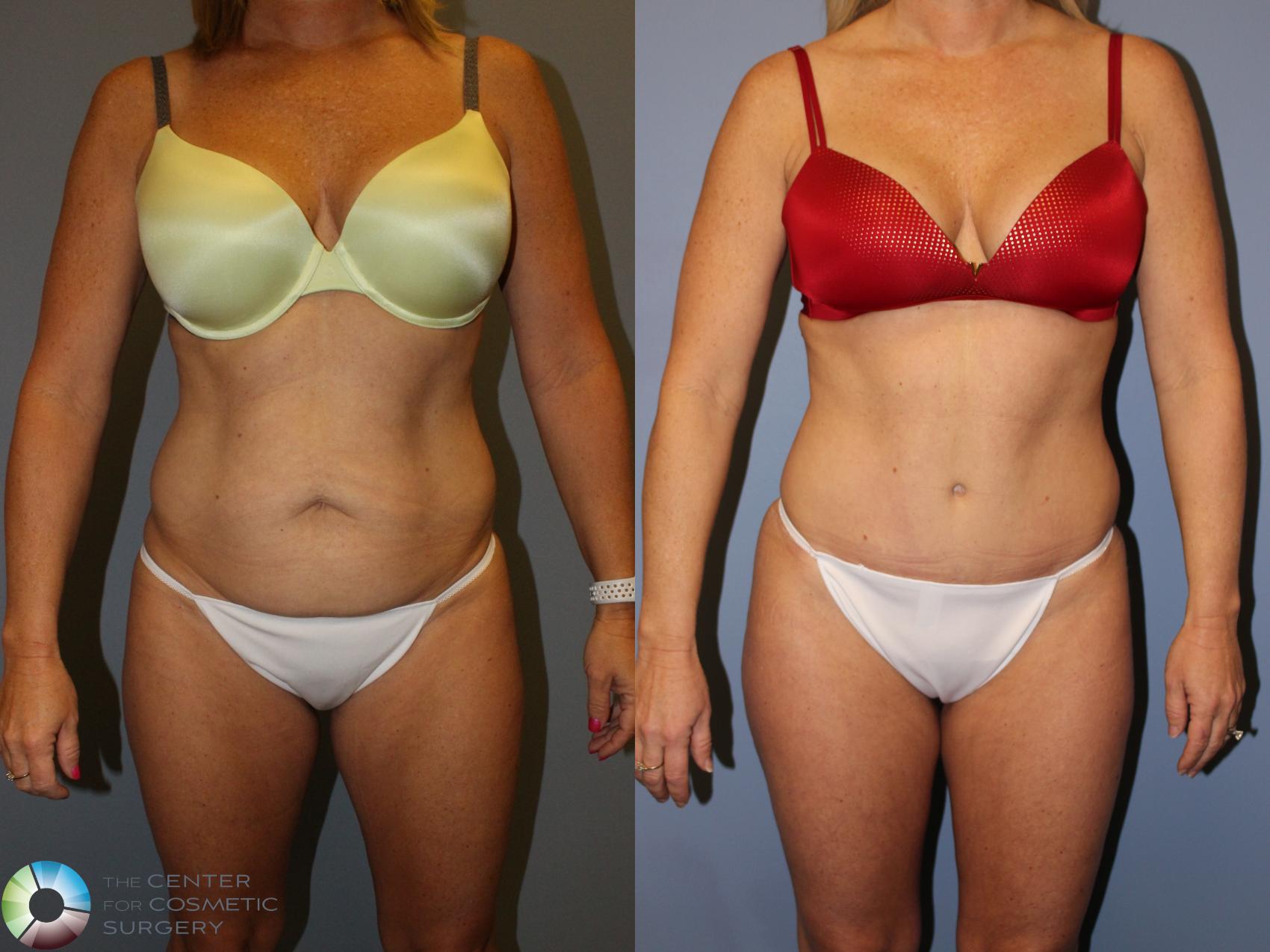 Before & After Tummy Tuck Case 11248 Front View in Golden, CO