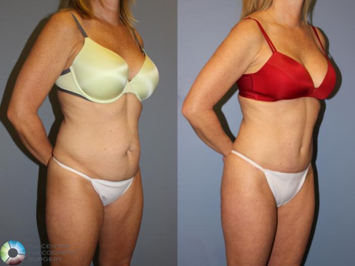 Before & After Tummy Tuck Case 11248 Right Oblique View in Golden, CO