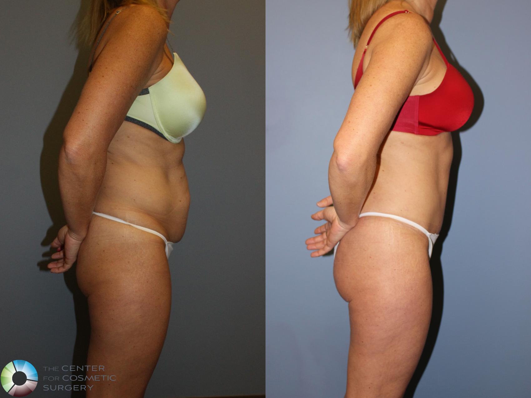 Before & After Tummy Tuck Case 11248 Right Side View in Golden, CO