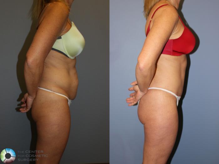 Before & After Tummy Tuck Case 11248 Right Side View in Golden, CO