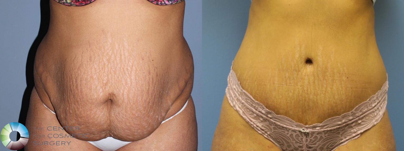 Before & After Tummy Tuck Case 11268 Front in Denver and Colorado Springs, CO