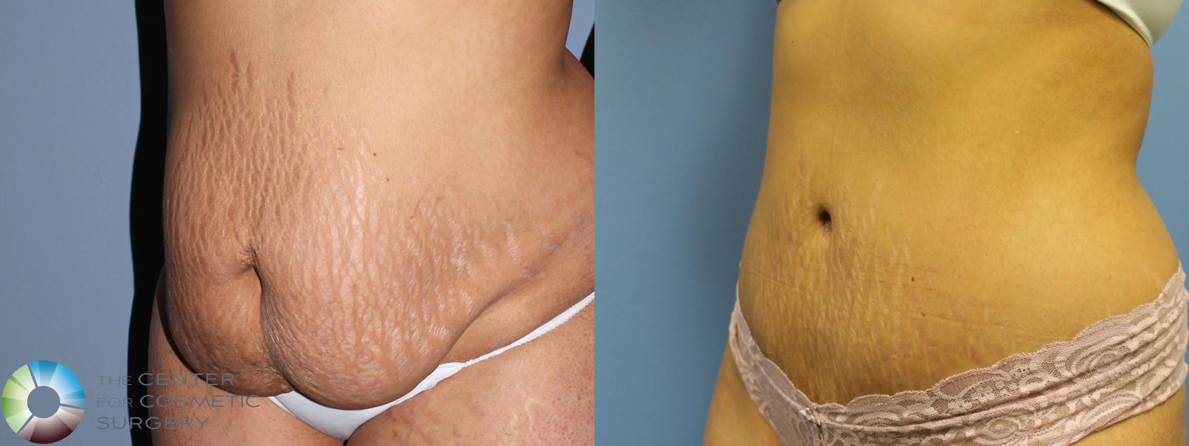 Before & After Tummy Tuck Case 11268 Left Oblique in Denver and Colorado Springs, CO