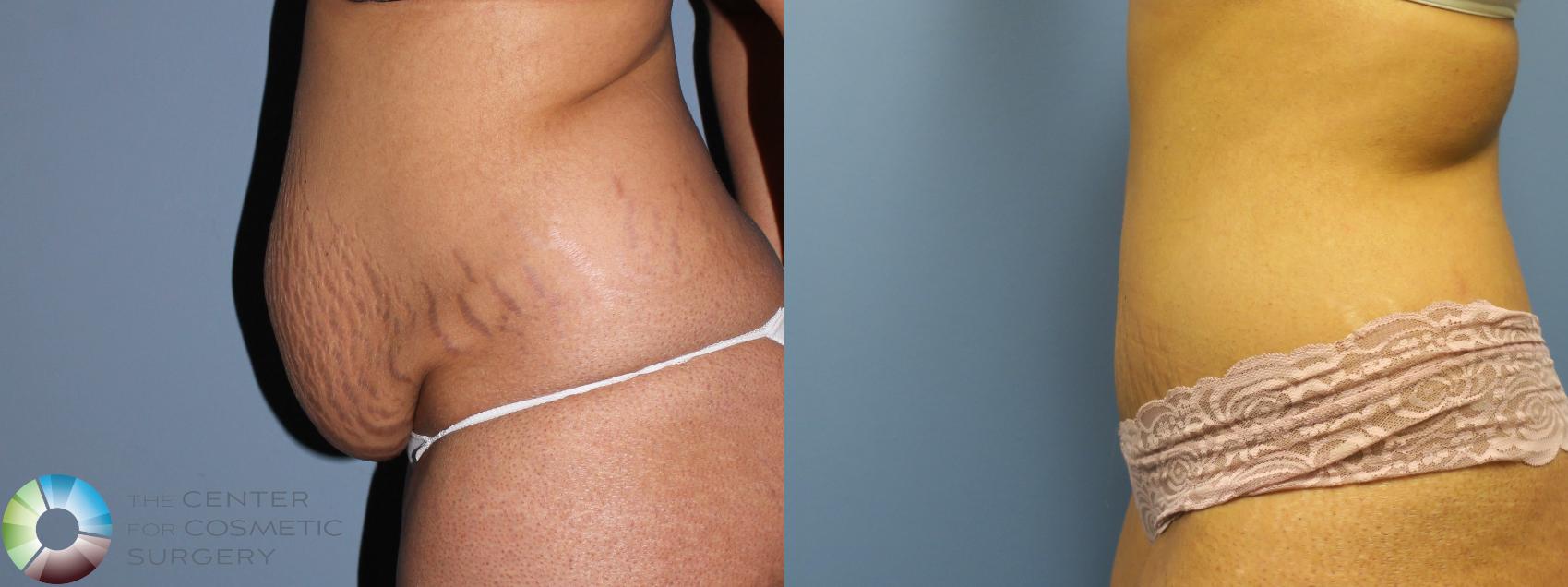 Before & After Tummy Tuck Case 11268 Left Side in Denver and Colorado Springs, CO