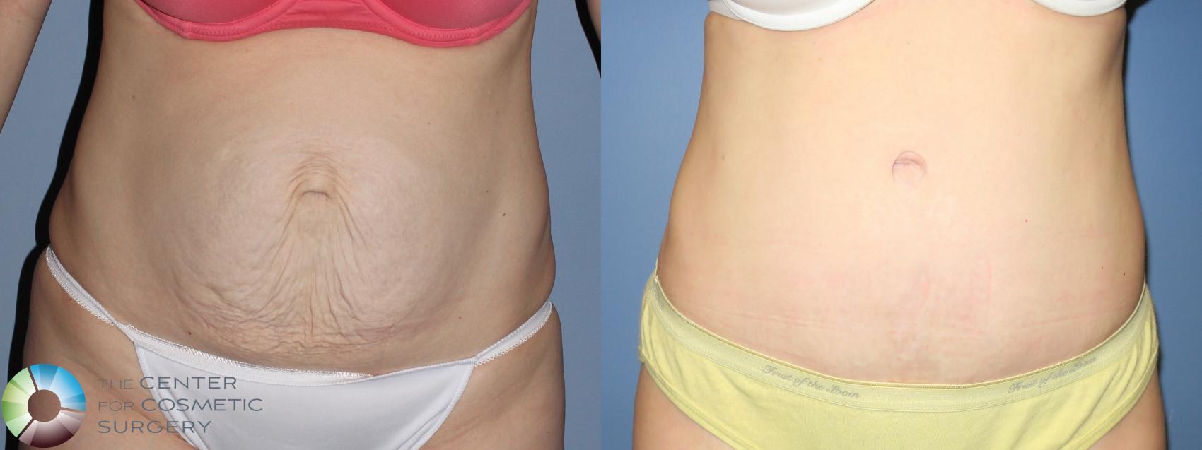 Denver Abdominoplasty Tummy Tuck