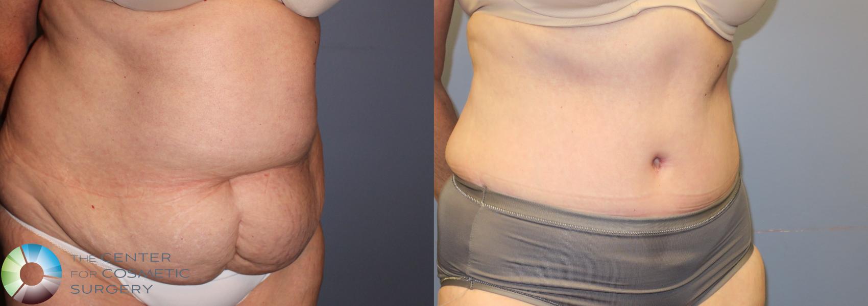 Denver Abdominoplasty Tummy Tuck