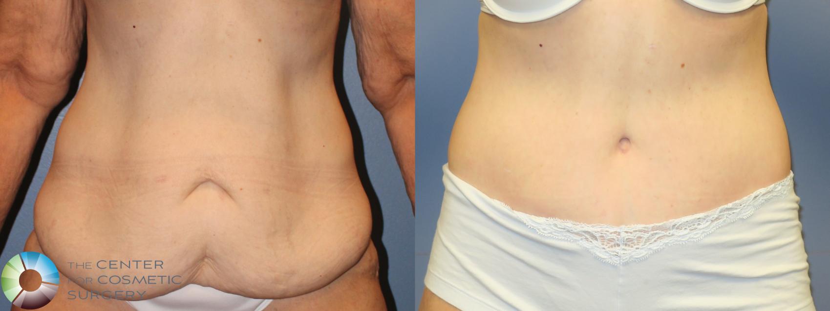 Before & After Tummy Tuck Case 11279 Front in Denver and Colorado Springs, CO