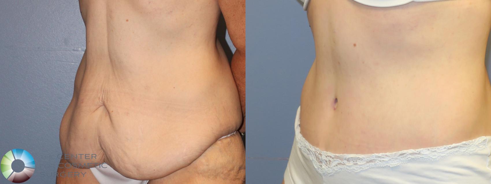 Before & After Tummy Tuck Case 11279 Left Oblique in Denver and Colorado Springs, CO