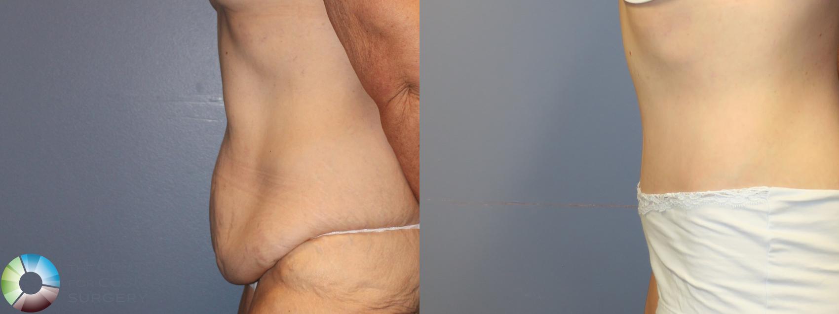 Before & After Tummy Tuck Case 11279 Left Side in Denver and Colorado Springs, CO