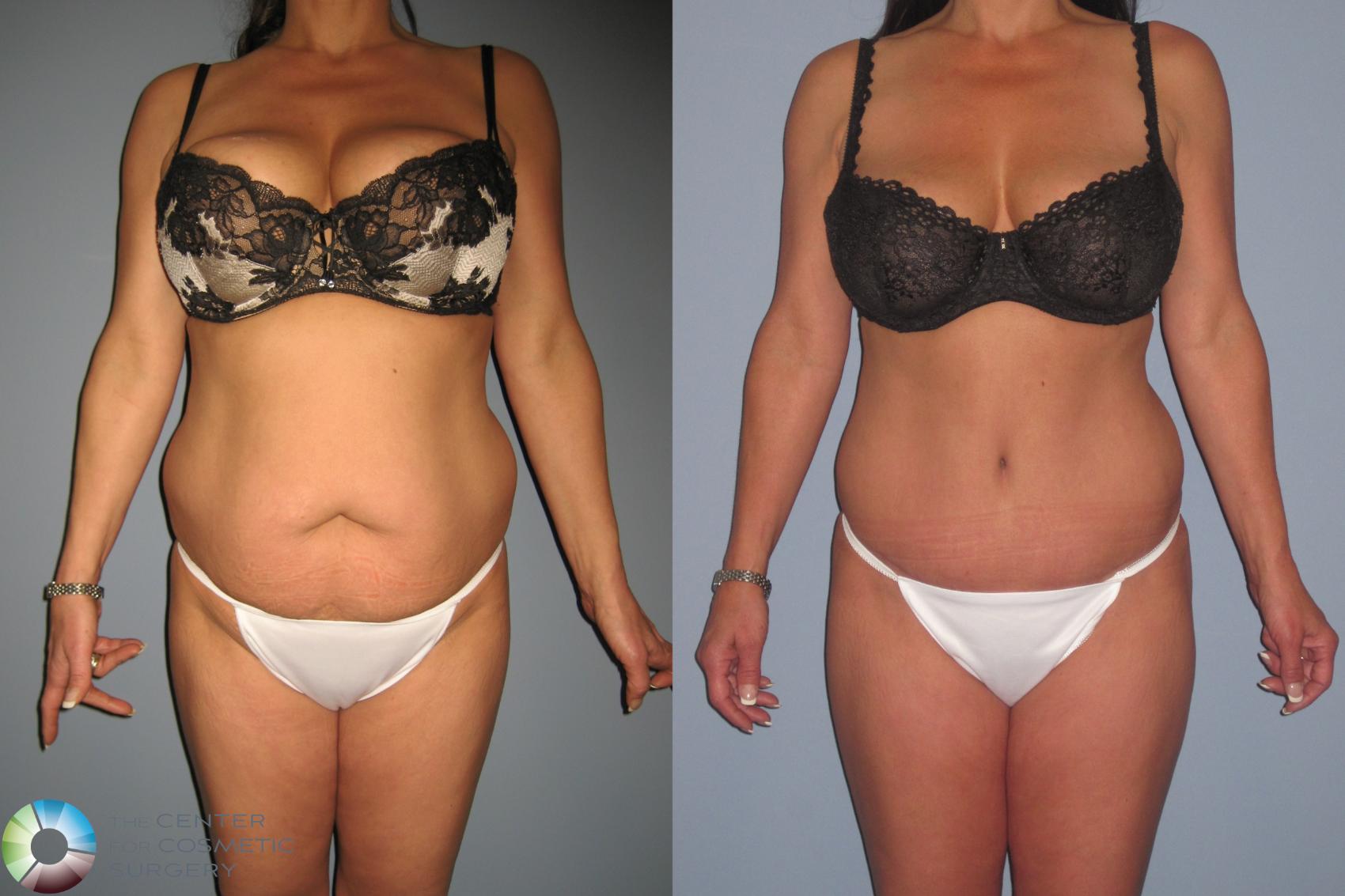 Before & After Tummy Tuck Case 11334 Front in Denver and Colorado Springs, CO