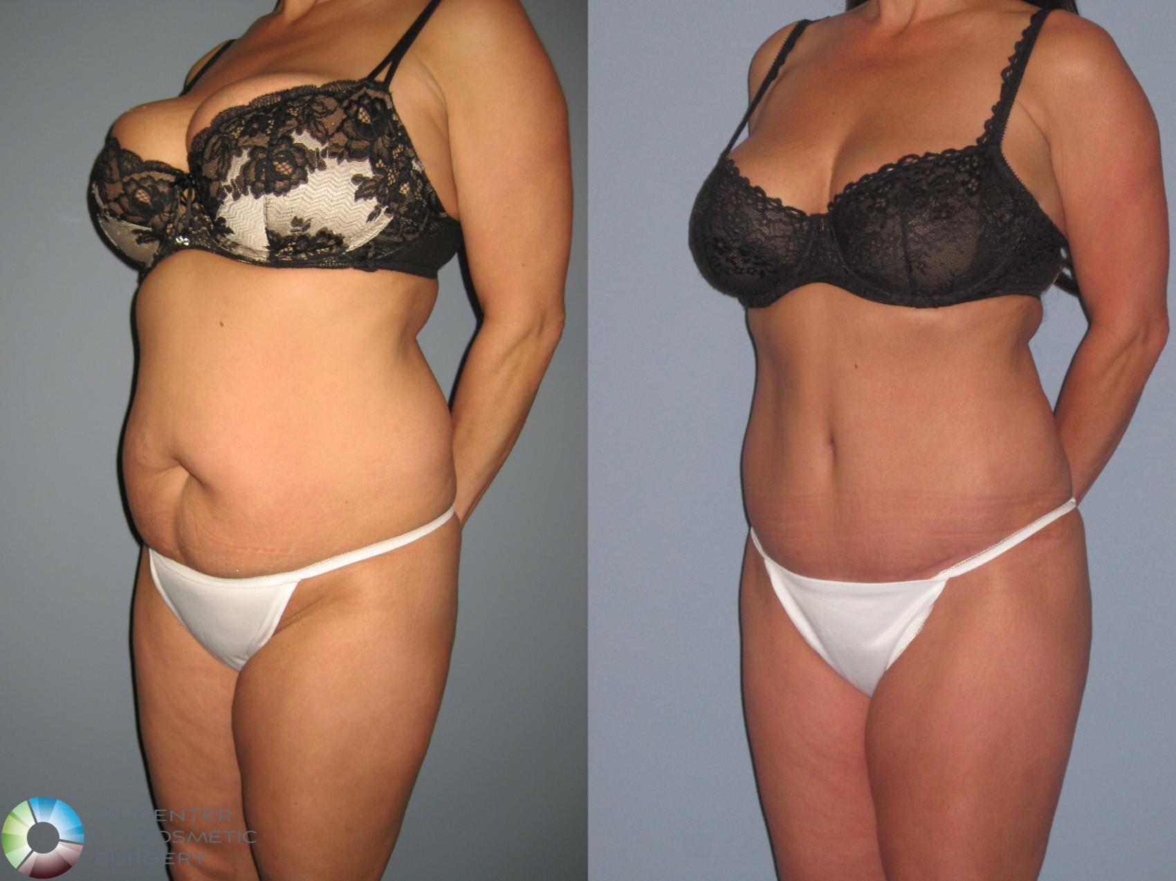 Before & After Tummy Tuck Case 11334 Left Oblique View in Golden, CO