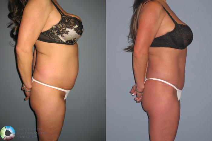 Before & After Tummy Tuck Case 11334 Right Side View in Golden, CO