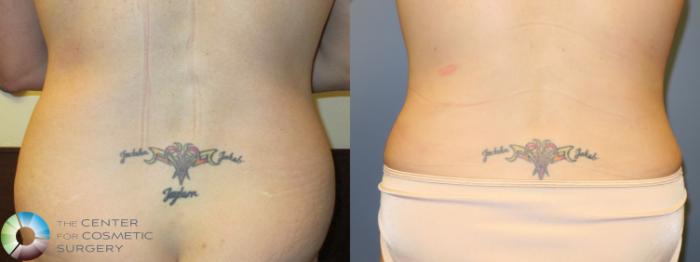 Before & After Tummy Tuck Case 11381 Back in Denver and Colorado Springs, CO