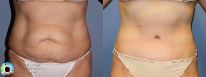 Before & After Tummy Tuck Case 11381 Front in Denver and Colorado Springs, CO