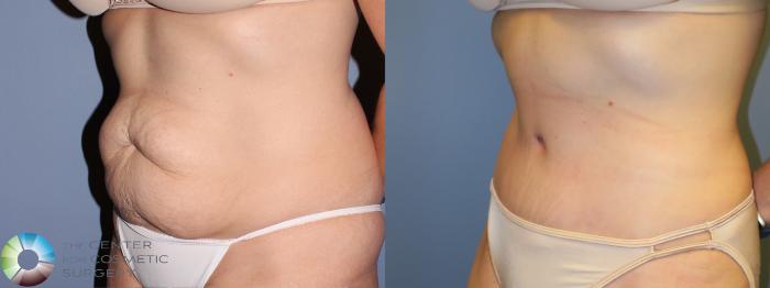 Before & After Tummy Tuck Case 11381 Left Oblique in Denver and Colorado Springs, CO